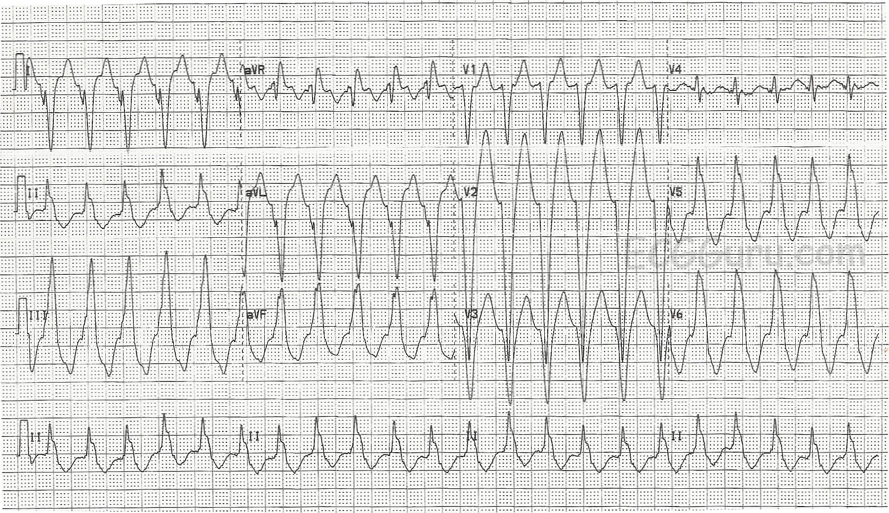 Right Ventricular Outflow Tract Tachycardia Rvot Ecg Guru